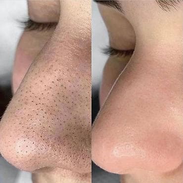 массаж для ног апарат: Чистка лица + фонофорез 💰 всего 1000 сом Что даст процедура: • — 3