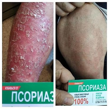 мазь: Здравствуйте! Найден эффективный способ от Псориаза. Я сам болею этой — 4