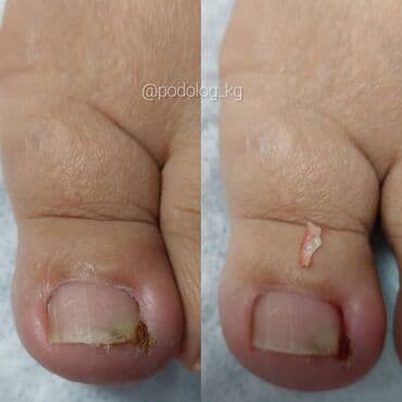 сколько стоит обучение на маникюр: Коррекция вросших ногтей, Услуги подолога, Педикюр, Одноразовые расходные материалы, Консультация — 5