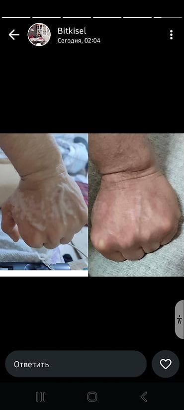 spf: Растительный крем для кожи с гипопигментацией (витилиго) - Формула на — 1