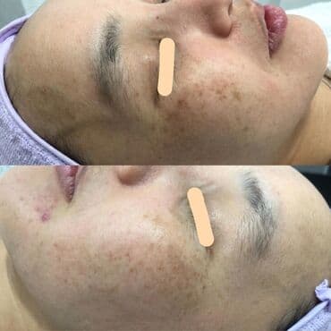 хиджама кровопускание: Косметология, Чистка кожи, Биоревитализация, Пилинг, Сертифицированный косметолог, Гипоаллергенные материалы, Консультация — 3