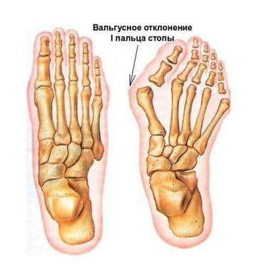 резинка для тренировки: Тренажер для упражнений при "косточке" на стопе. С помощью него можно — 2