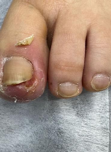 подолог бишкек фото: Коррекция вросших ногтей, Ремонт сломаных ногтей, Снятие, Маникюр, Педикюр, Услуги подолога, Консультация, С выездом на дом, Требуются модели — 2