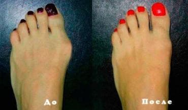 вальгусная шина купить: Корректоры для большого пальца ноги от вальгусной деформации(косточки — 2