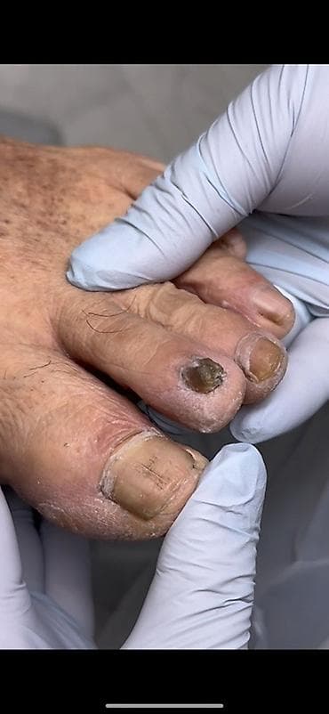 лечение грибка ногтей бишкек: Подологический уход за стопами и ногтями Профессиональные процедуры — 2