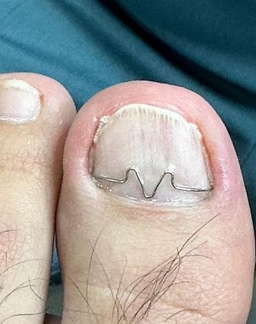 мазоли: Ремонт сломаных ногтей, Снятие, Коррекция вросших ногтей, Маникюр, Педикюр, Услуги подолога, С выездом на дом, Консультация, Требуются модели — 3