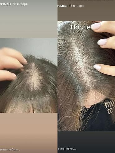 от перхоти: Средство против выпадения волос Эсвицин лосьон-тоник 250мл Россия — 2