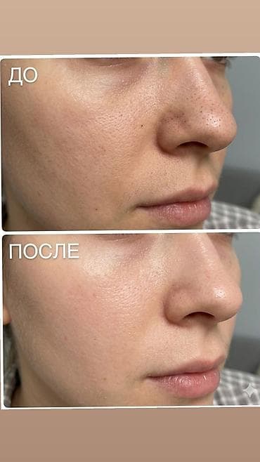 скрабер: Профессиональная чистка лица у вас дома! ✨ Продаю ультразвуковой — 4