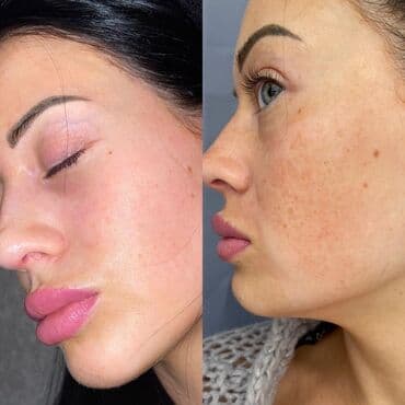 эффективный отбеливающий крем для зоны бикини в аптеке: Expigment Экспигмент Сроки до 2027 Свежая поставка с Турции 🇹🇷 💯% — 14