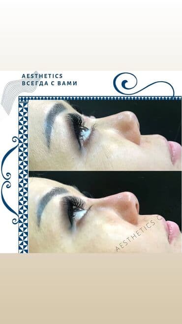 нейлоновые зубные протезы в бишкеке цены: Косметология, Ботокс, Биоревитализация, Ботулинотерапия, Консультация, Гипоаллергенные материалы, Сертифицированный косметолог — 1