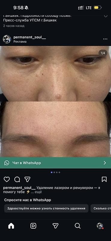 Татуировкаларды өчүрүү | Консультация — 1