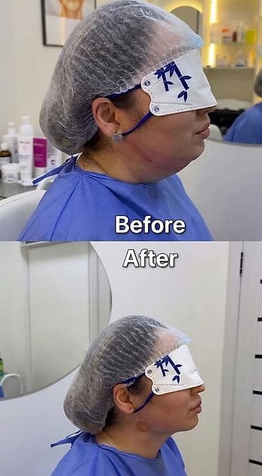 Липосакция второго подбородка и брыли по Акции вместо 35000с со