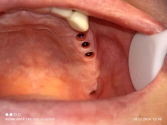 хиджама кровопускание: Клиника | Стоматолог | Протезирование — 16