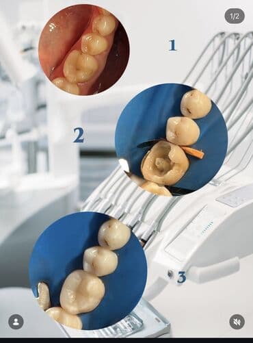 лечение алкоголизма: Акция на лечение кариеса Зубов !!!!Реставрация зубов композитными — 2