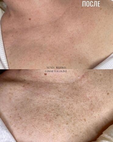 узи с выездом на дом бишкек: . Чистка лица, пилинги, инъекции красоты, ботокс, биоревитализация — 4