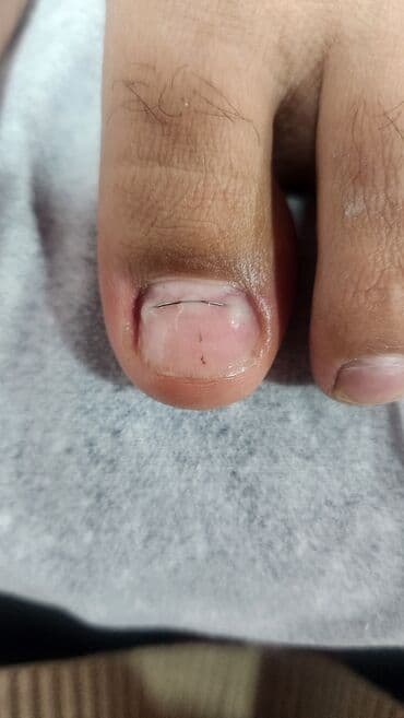 пластик для потолка цена бишкек: Коррекция вросших ногтей, Услуги подолога, Консультация — 2