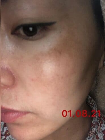 эффективный отбеливающий крем для зоны бикини в аптеке: Expigment Экспигмент Сроки до 2027 Свежая поставка с Турции 🇹🇷 💯% — 15