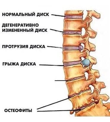 массаж швз: Массаж | Остеохондроз, Межпозвоночная грыжа, Протрузия | С выездом на дом, Консультация — 13