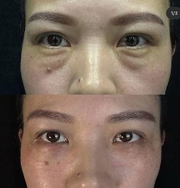 редми 10 прайм: Блефаропластика верхних и нижних век Опытный хирург - Хирургическая — 4