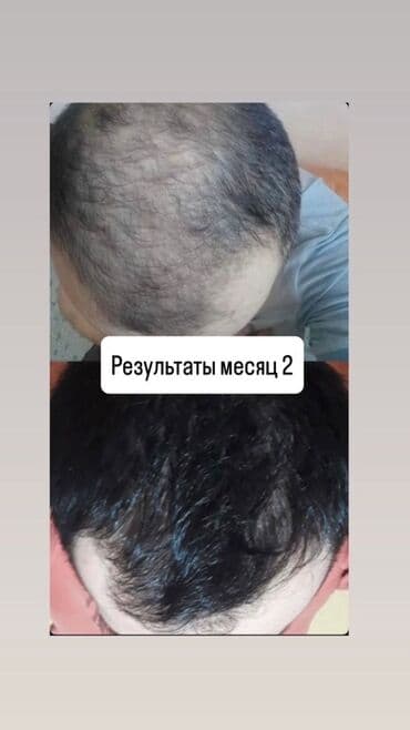 эко спрей от вшей как пользоваться: Сыворотка для роста волос и бороды RIJAL REAXIDIL 15% - Активный — 1