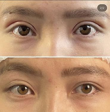 редми 10 прайм: Блефаропластика верхних и нижних век Опытный хирург - Хирургическая — 6