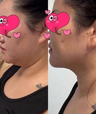 Бани, сауны, SPA: --Саламатсызбы 💎 ЭЭК АСТЫ ЖАНА ХОЛКА ЛИПОСАКЦИЯСЫ *Ээк асты – — 1