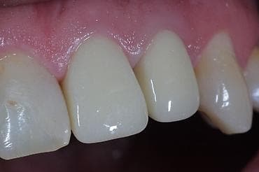 реска бетон: Стоматологическая услуга: реставрация передних зубов с применением — 4