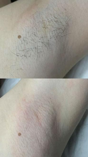 Шугаринг на все тело at lalafo.kg Шугаринг на все тело