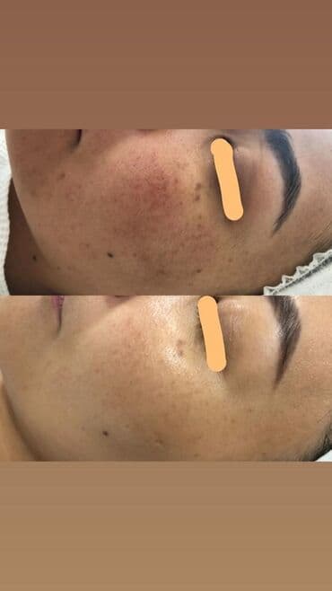 хиджама кровопускание: Косметология, Чистка кожи, Биоревитализация, Пилинг, Сертифицированный косметолог, Гипоаллергенные материалы, Консультация — 9