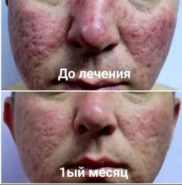 медсестра на дом бишкек мкр: Врачи | Дерматолог | Диагностика, Консультация — 1