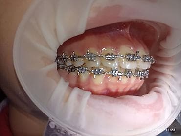 Ортезы: Ортодонтическое лечение: установка брекет‑системы на нижнюю челюсть - — 8