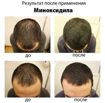миноксидил ультра: Kirkland Signature Minoxidil 5% Topical Solution, Extra Strength for — 8