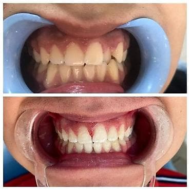 брекеты цена бишкек 2020: К вашему вниманию предоставляется услуга по установке брекет-системы — 1