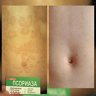 мазь: Здравствуйте! Найден эффективный способ от Псориаза. Я сам болею этой — 8