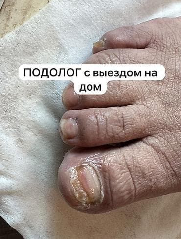 лечение грибка ногтей бишкек: Коррекция вросших ногтей, Педикюр, Одноразовые расходные материалы — 1