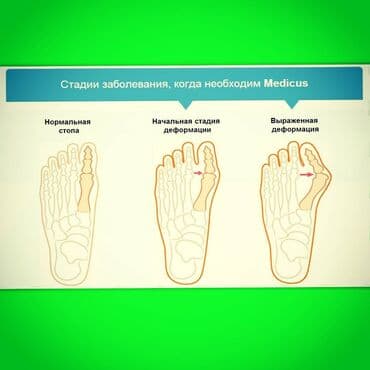 корректор для большого пальца ноги бишкек: Корректоры для большого пальца ноги от вальгусной деформации(косточки — 1