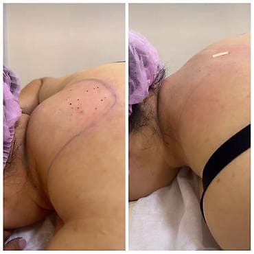 лицо: Липосакция второго подбородка и брыли по Акции вместо 35000с со — 9