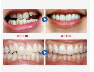 резиновый дилдо: Зубные ортодонтические брекеты для выравнивания зубов. Материал — 4