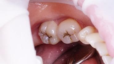 услуги стоматологии: Стоматолог Бишкек. Профессиональная чистка. Лечение кариеса и его — 5