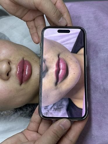 подтяжка лица: Увеличение и моделирование губ филлерами - Эстетическая коррекция — 2