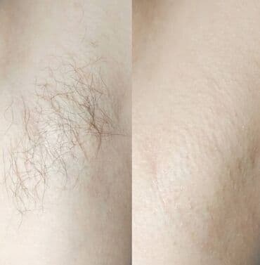 хиджама кровопускание: Шугаринг!!!! Я Бегайым!🌸 мастер с 5️⃣ летним стажем и с медицинским — 3