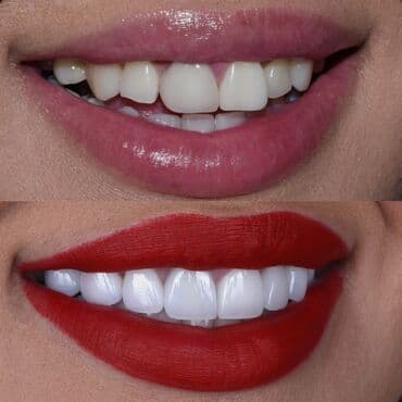 художественная реставрация зубов композитными материалами: Эстетическая стоматология — установка виниров - Услуга направлена на — 1
