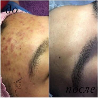 хиджама кровопускание: Косметология, Чистка кожи, Биоревитализация, Пилинг, Сертифицированный косметолог, Гипоаллергенные материалы, Консультация — 2