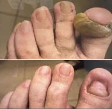 на дом керек: Услуги подолога, С выездом на дом, Консультация, Одноразовые расходные материалы — 5