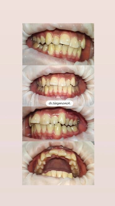 отбеливание зубов: Врачи, Клиника | Стоматолог | Консультация — 5