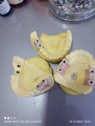 хиджама кровопускание: Клиника | Стоматолог | Протезирование — 8