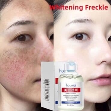 крем для отбеливания кожи и устранения пигментных пятен: От пигментации От пигментных пятен От веснушек Эссенция, поглощающая — 6