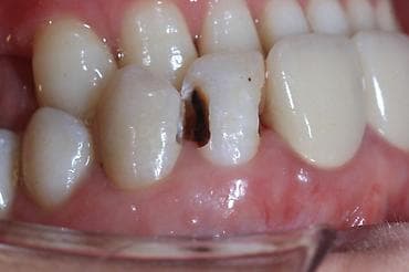 Реставрация передних зубов композитом (эстетическая пломба) - — 2