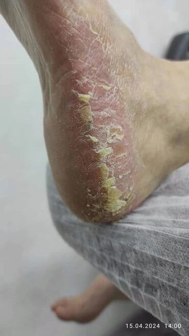 медсестра на дом бишкек мкр: Выравнивание, Наращивание ногтей, Донаращивание ногтей, Маникюр, Педикюр, Услуги подолога, С выездом на дом, Консультация, Одноразовые расходные материалы — 5