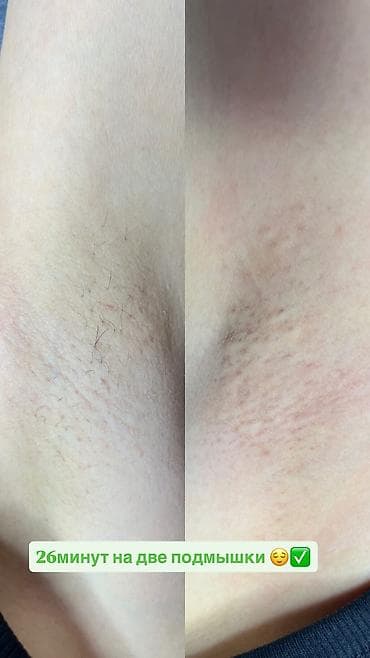 Сулуулук жана ден-соолук: Электроэпиляция — профессиональное удаление волос с любой зоны — 6